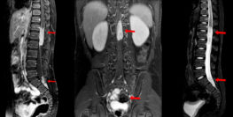 spinal cord injury xray