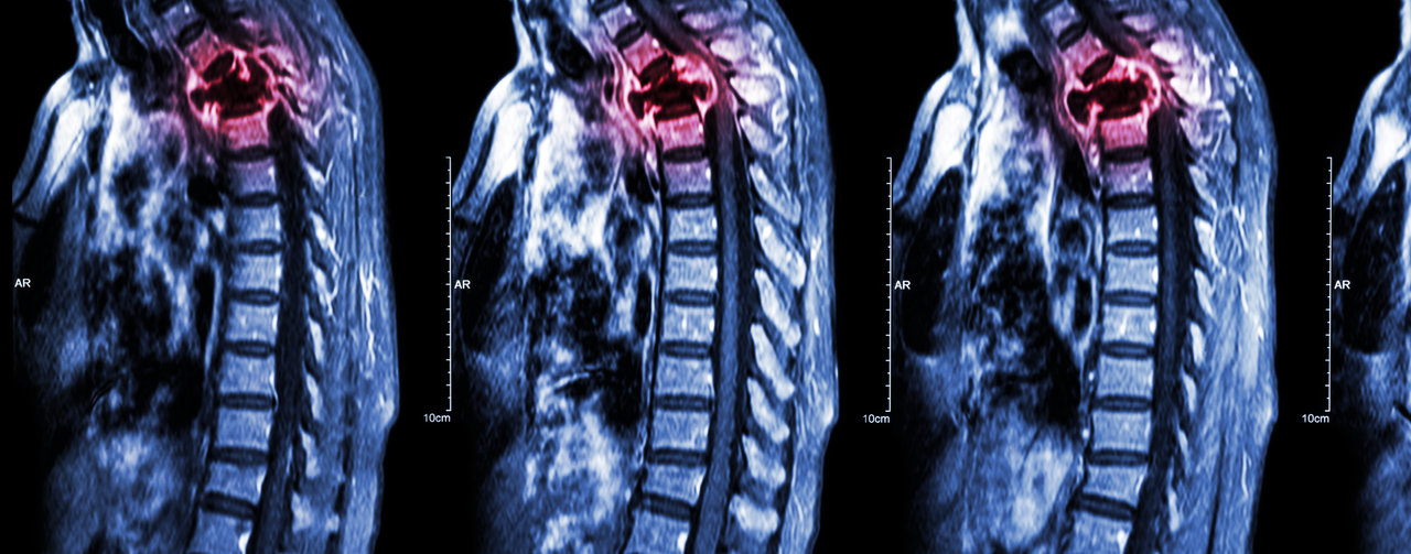 spinal cord injury xray