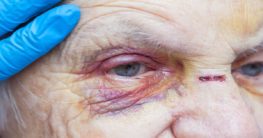 injured elderly due to abuse